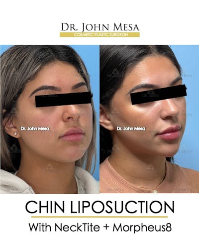 Chin Liposuction Before & After Gallery - Patient 157104125 - Image 2