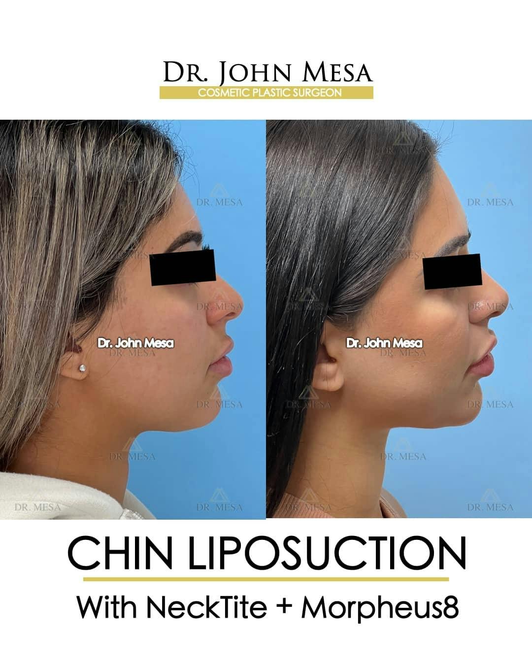 Chin Liposuction Before & After Gallery - Patient 157104125 - Image 1