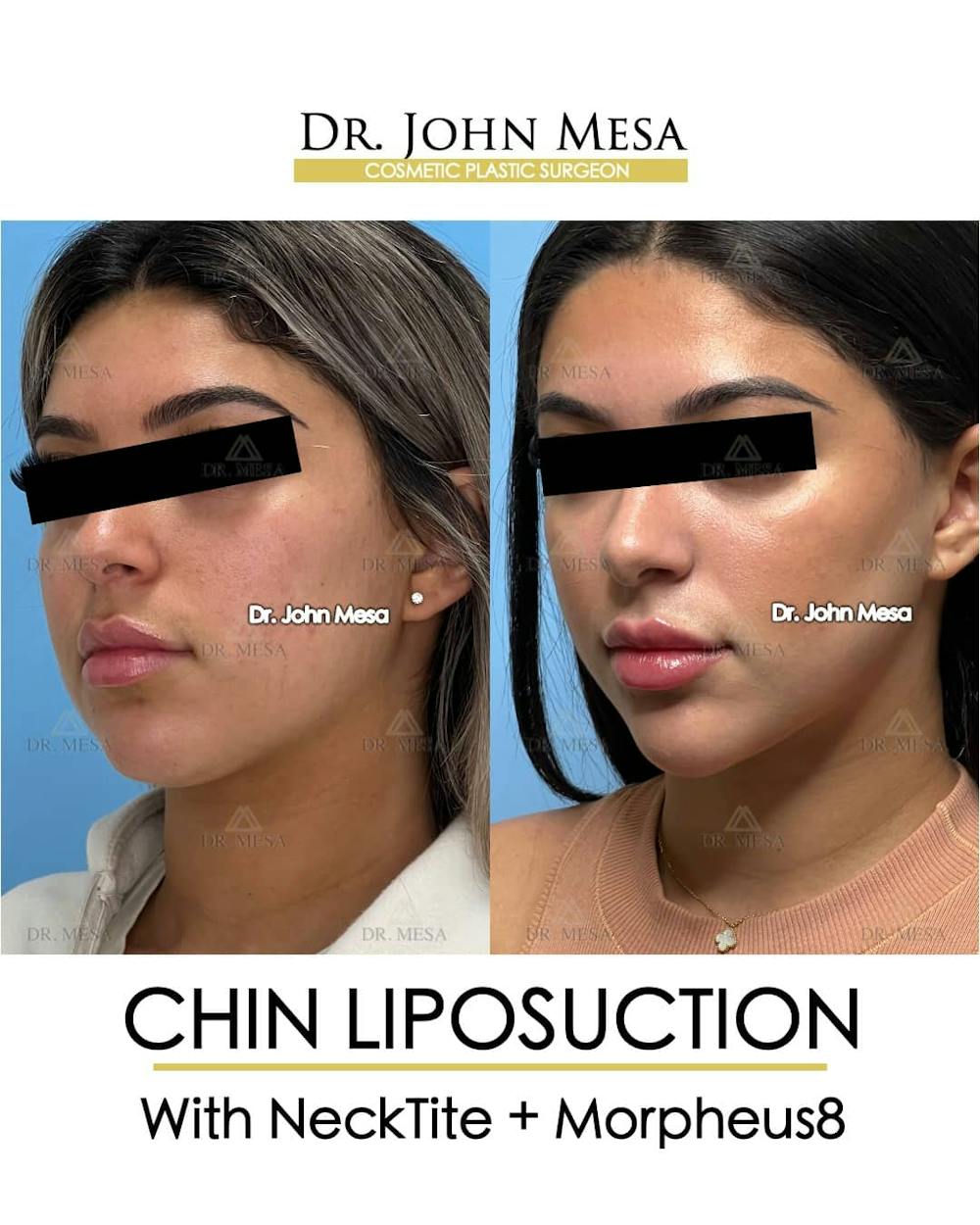 Chin Liposuction Before & After Gallery - Patient 157104125 - Image 4