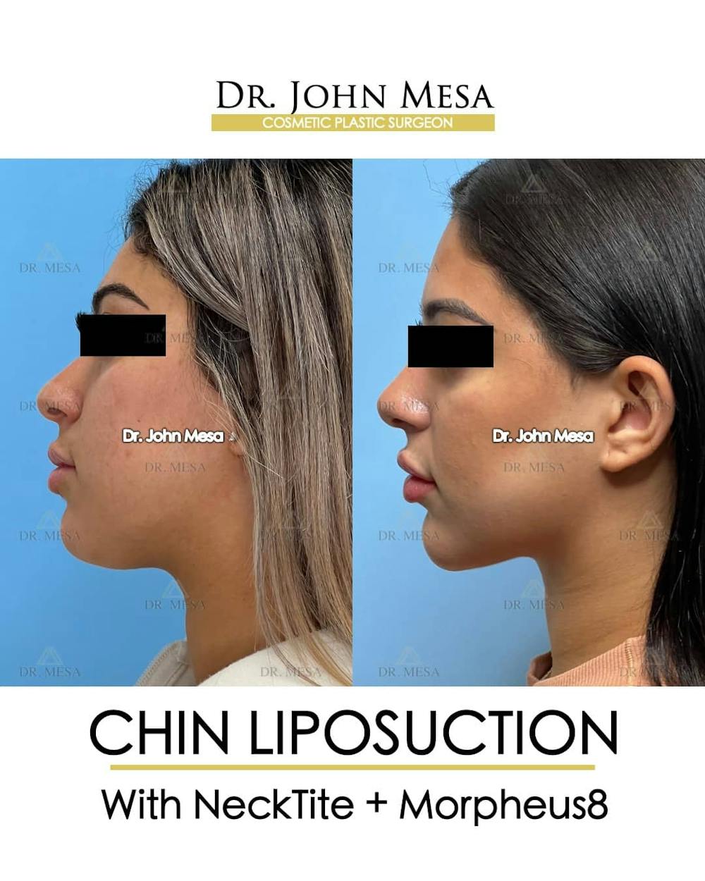 Chin Liposuction Before & After Gallery - Patient 157104125 - Image 5