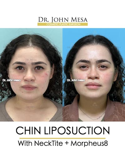 Chin Liposuction Before & After Gallery - Patient 157104127 - Image 2