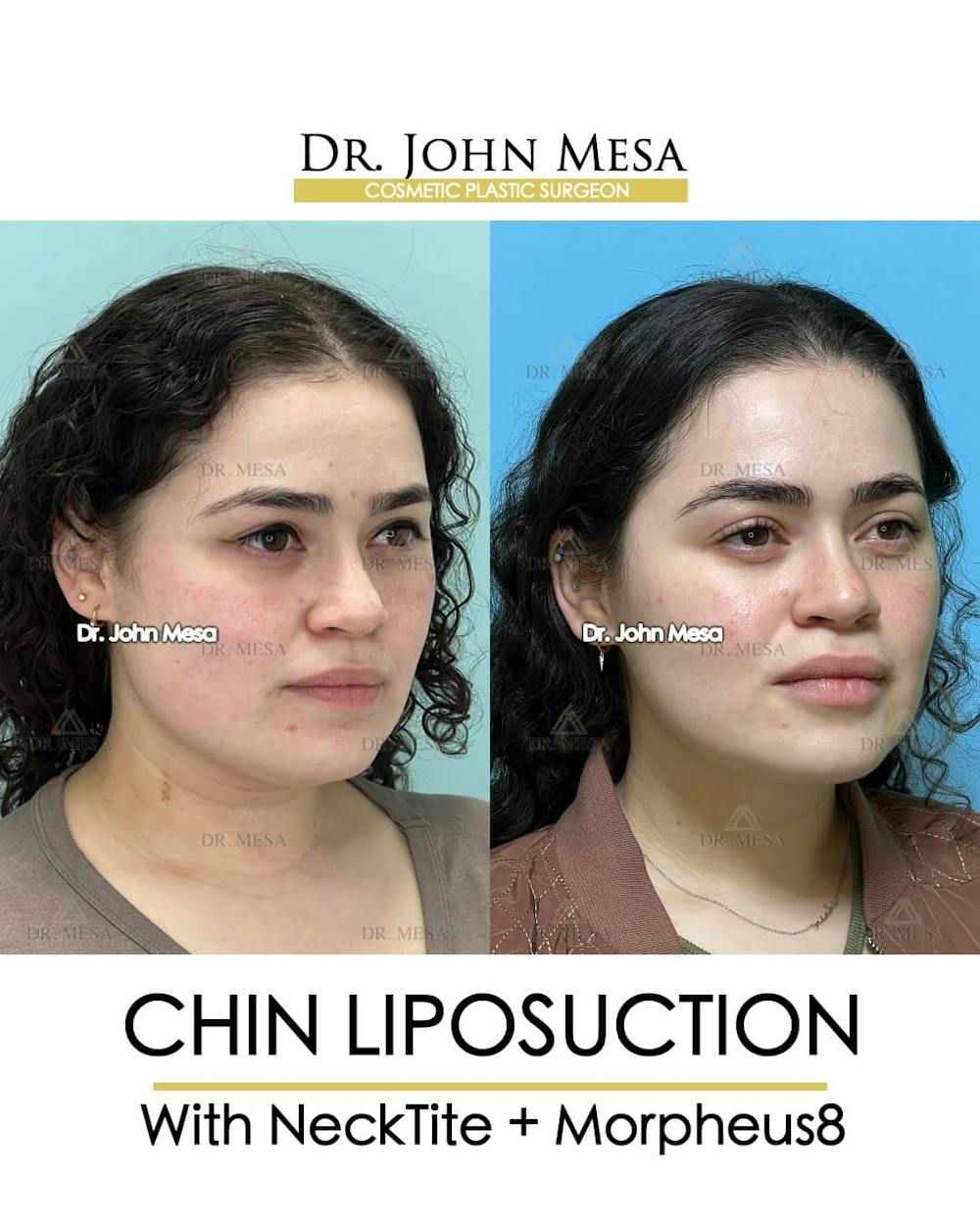 Chin Liposuction Before & After Gallery - Patient 157104127 - Image 3