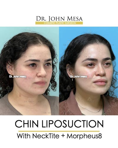 Chin Liposuction Before & After Gallery - Patient 157104127 - Image 2