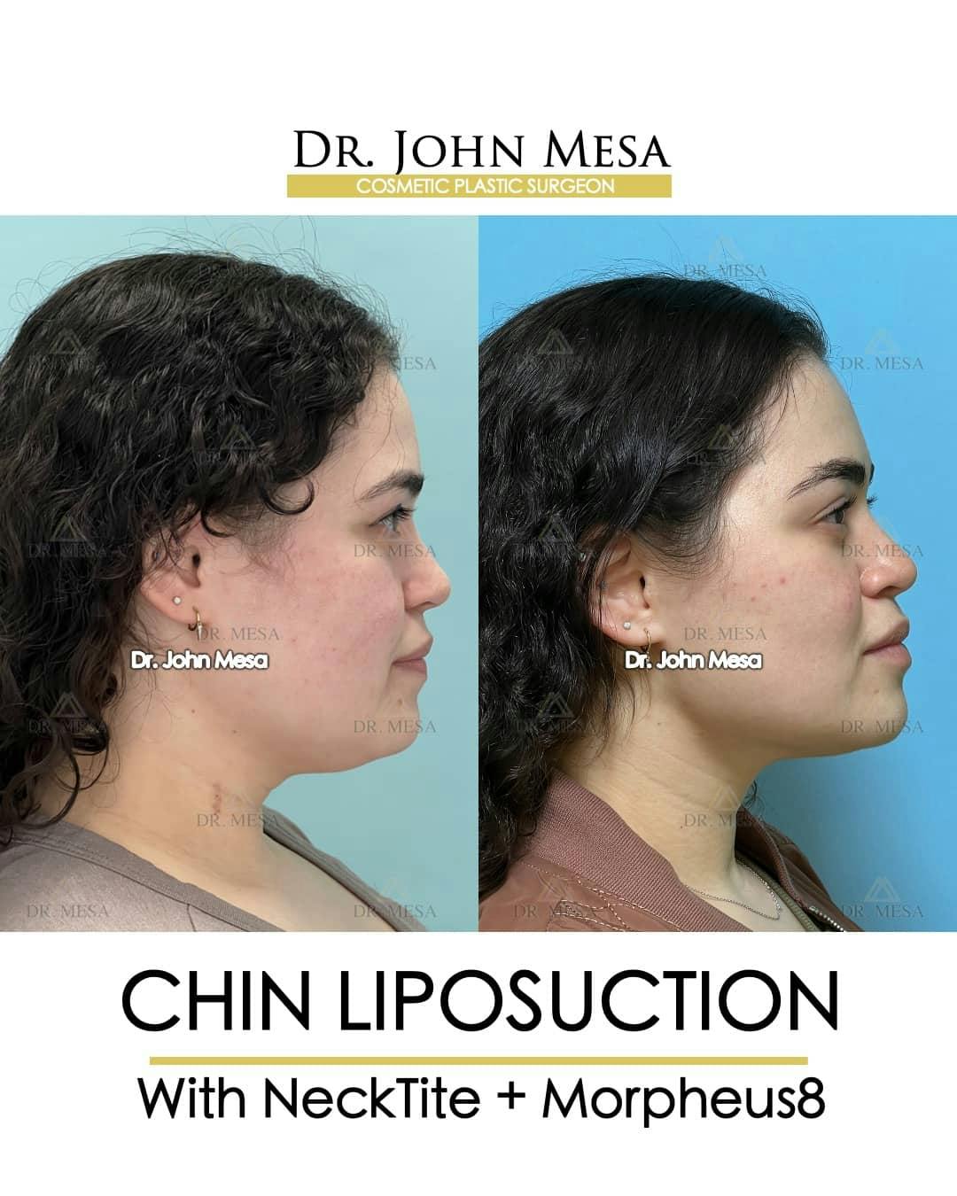 Chin Liposuction Before & After Gallery - Patient 157104127 - Image 1