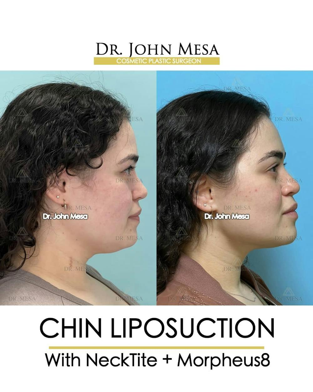 Chin Liposuction Before & After Gallery - Patient 157104127 - Image 3