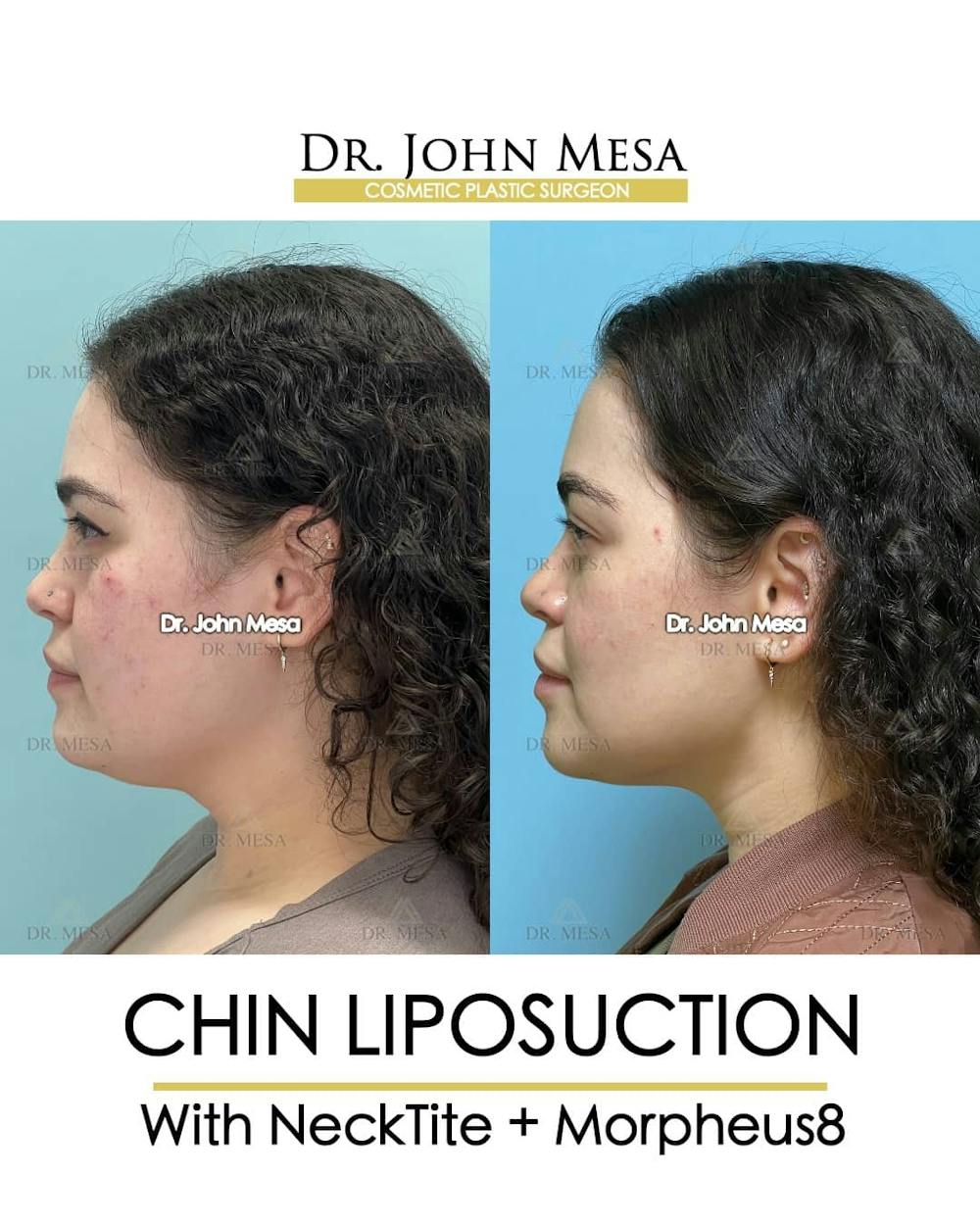 Chin Liposuction Before & After Gallery - Patient 157104127 - Image 5