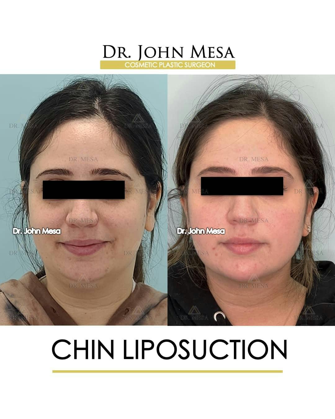 Chin Liposuction Before & After Gallery - Patient 157104128 - Image 1