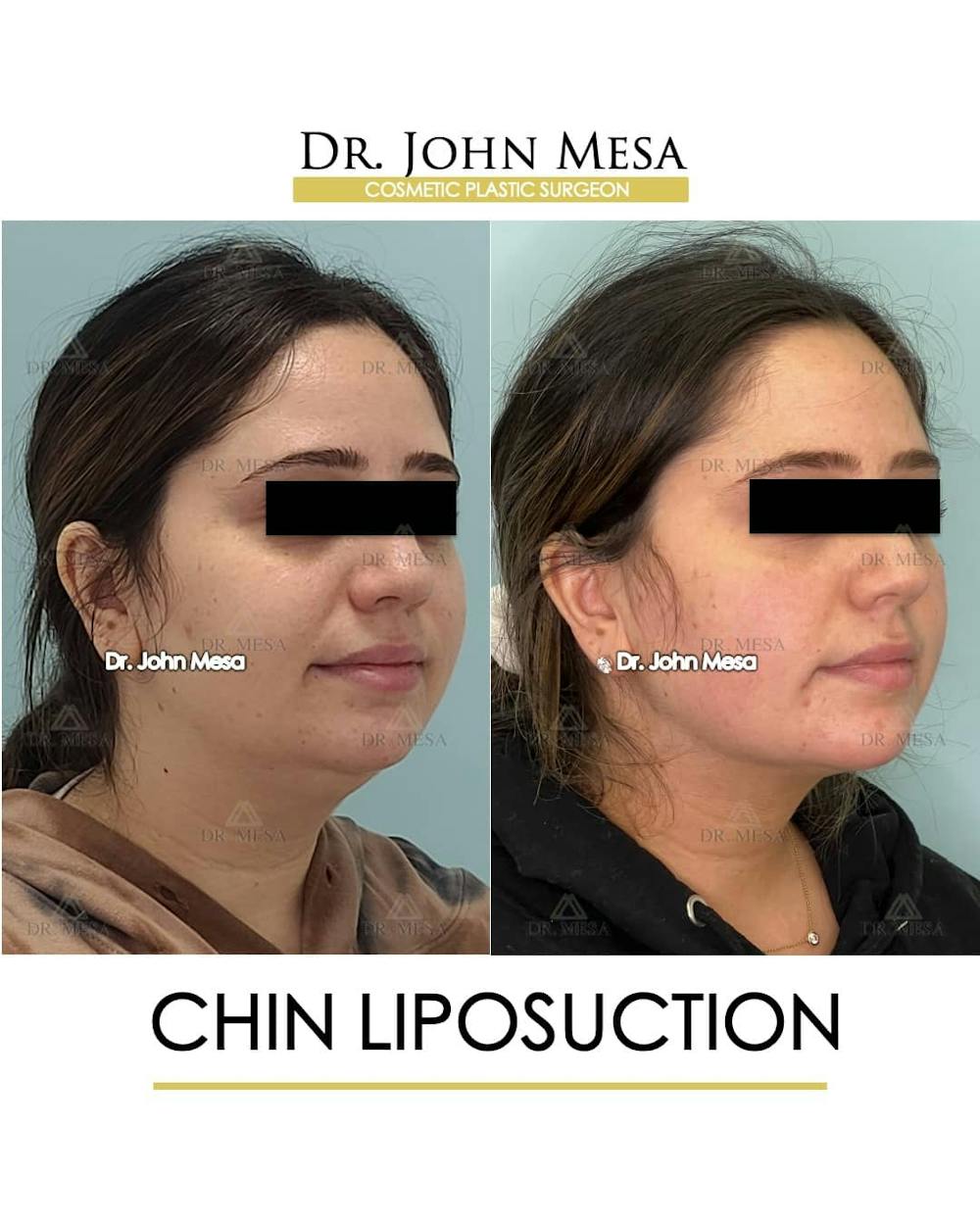 Chin Liposuction Before & After Gallery - Patient 157104128 - Image 3