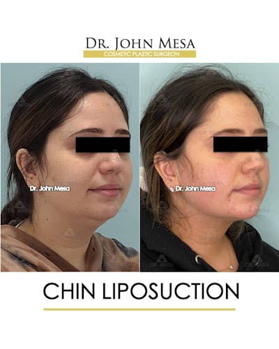 Chin Liposuction Before & After Gallery - Patient 157104128 - Image 2