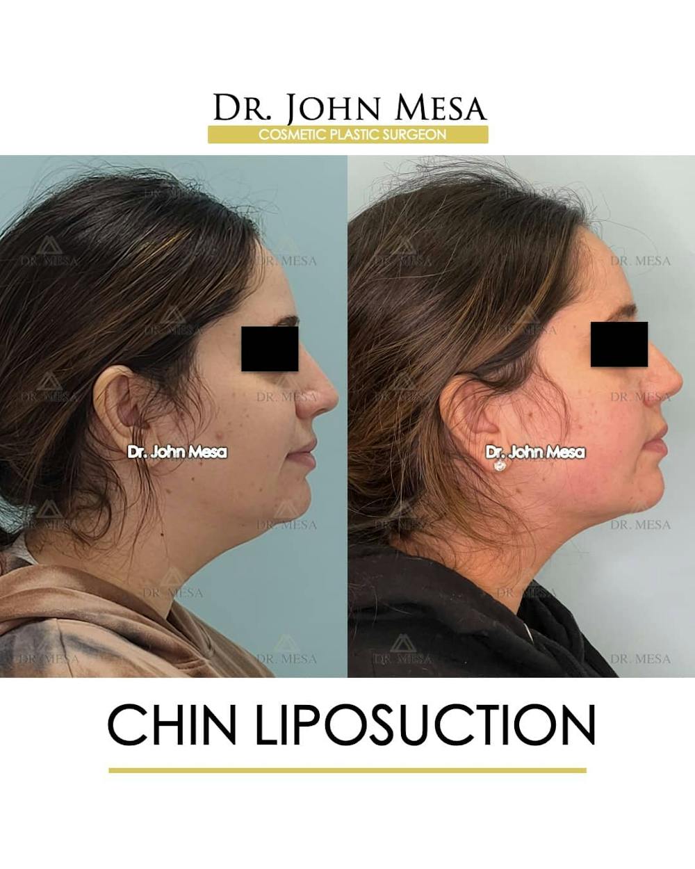 Chin Liposuction Before & After Gallery - Patient 157104128 - Image 3