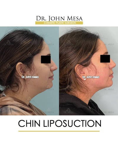 Chin Liposuction Before & After Gallery - Patient 157104128 - Image 1