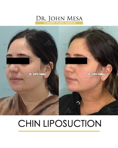 Chin Liposuction Before & After Gallery - Patient 157104128 - Image 4