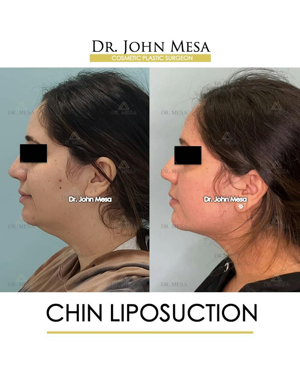 Chin Liposuction Before & After Gallery - Patient 157104128 - Image 5