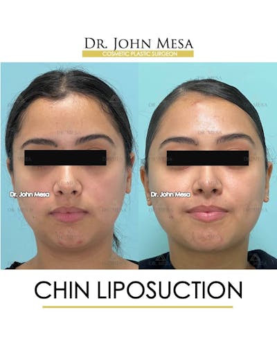 Chin Liposuction Before & After Gallery - Patient 157104129 - Image 2