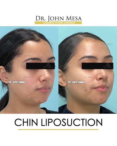 Chin Liposuction Before & After Gallery - Patient 157104129 - Image 2