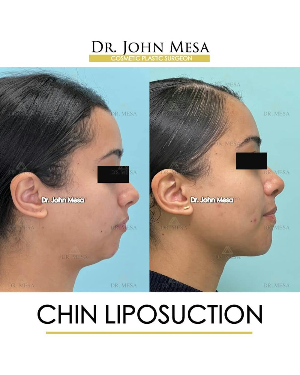 Chin Liposuction Before & After Gallery - Patient 157104129 - Image 3