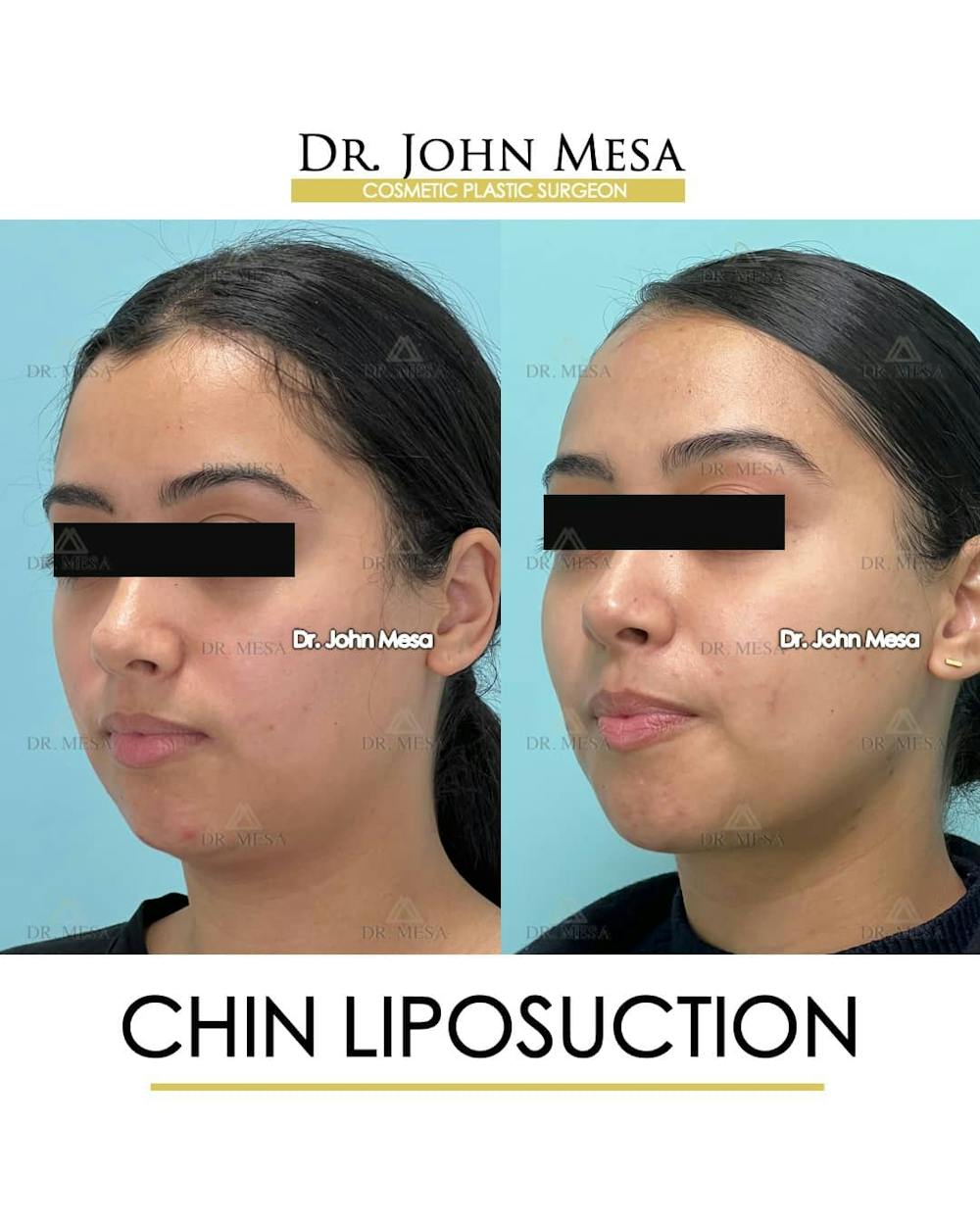 Chin Liposuction Before & After Gallery - Patient 157104129 - Image 4