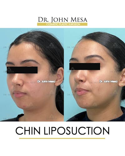 Chin Liposuction Before & After Gallery - Patient 157104129 - Image 4