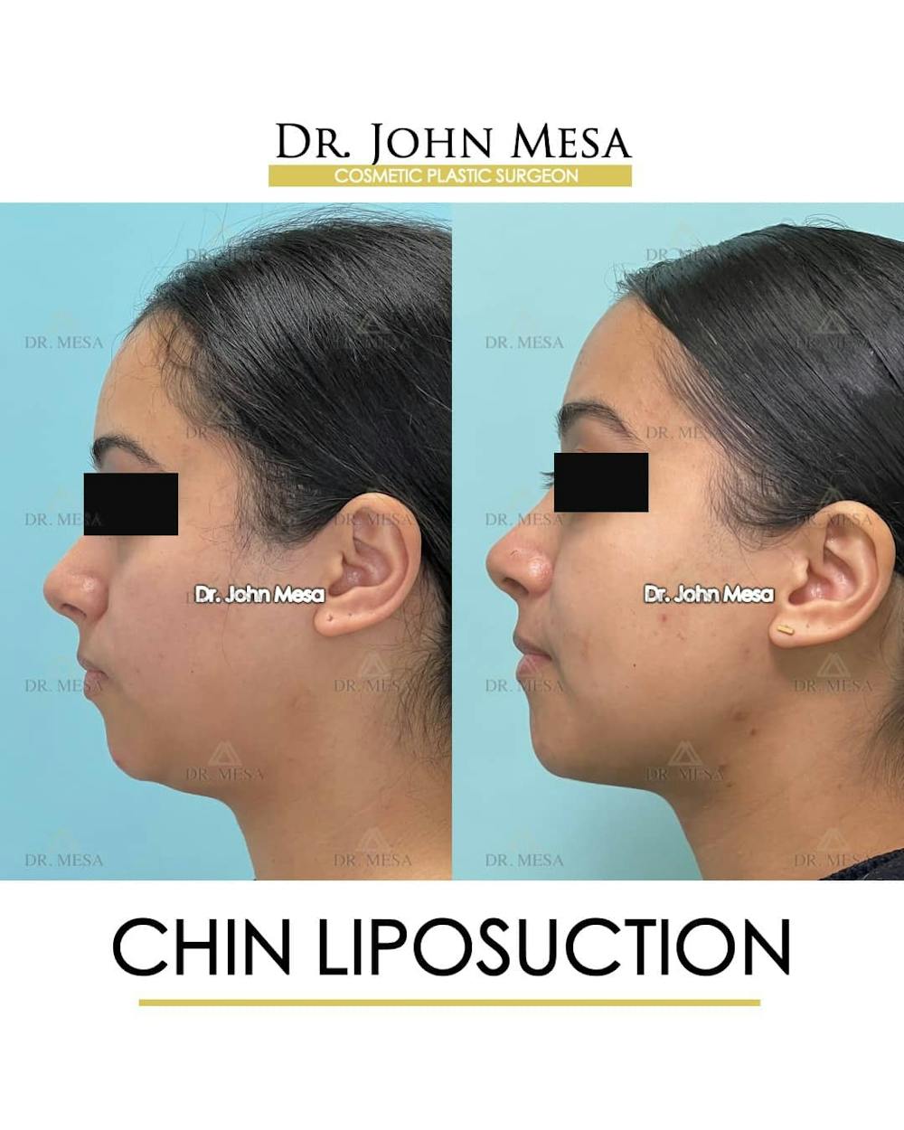 Chin Liposuction Before & After Gallery - Patient 157104129 - Image 5