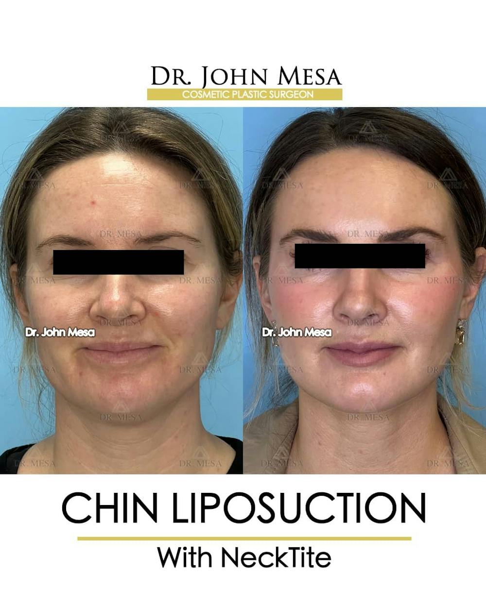 Chin Liposuction Before & After Gallery - Patient 157104132 - Image 2