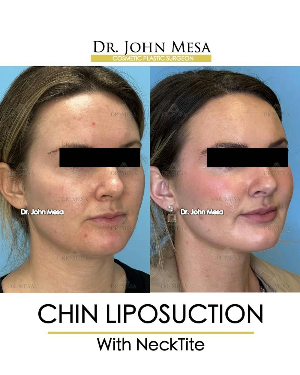 Chin Liposuction Before & After Gallery - Patient 157104132 - Image 3