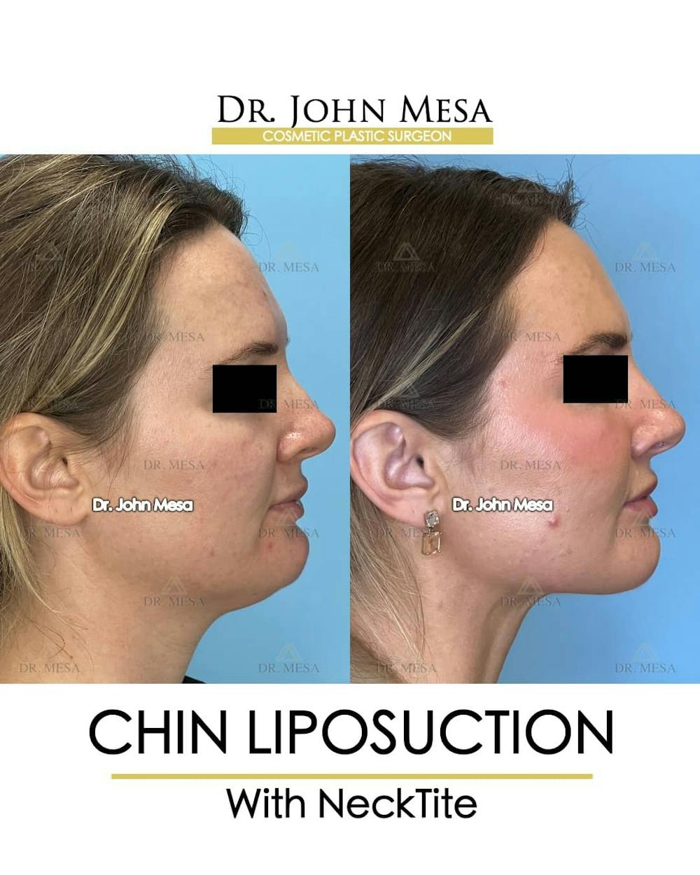 Chin Liposuction Before & After Gallery - Patient 157104132 - Image 3