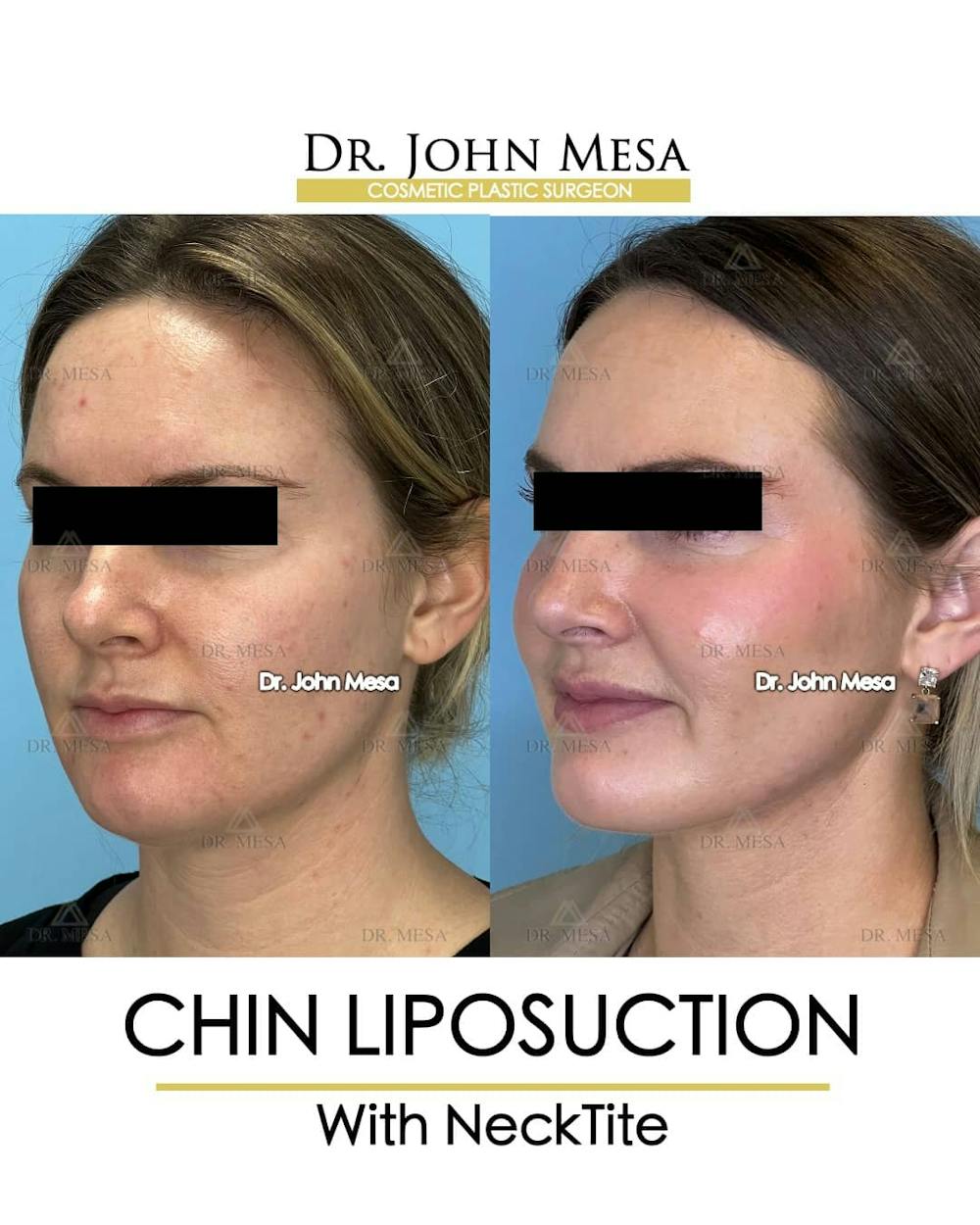 Chin Liposuction Before & After Gallery - Patient 157104132 - Image 4