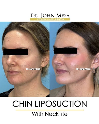 Chin Liposuction Before & After Gallery - Patient 157104132 - Image 4