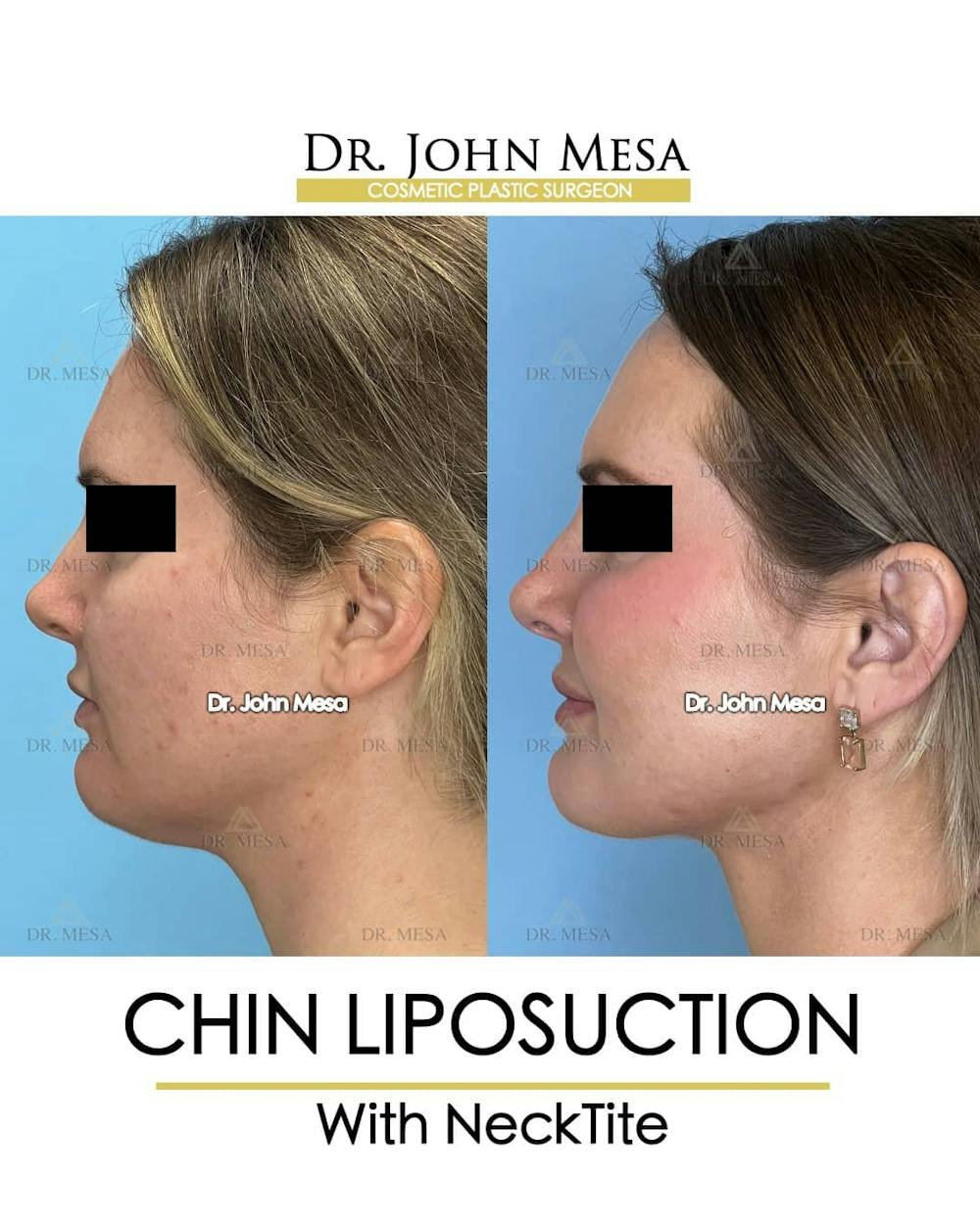 Chin Liposuction Before & After Gallery - Patient 157104132 - Image 5