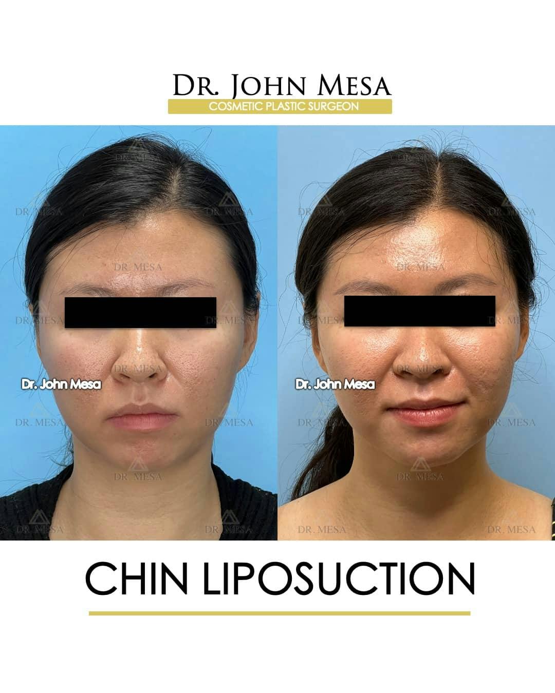 Chin Liposuction Before & After Gallery - Patient 157104130 - Image 1