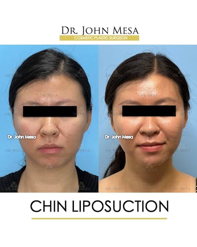 Chin Liposuction Before & After Gallery - Patient 157104130 - Image 1
