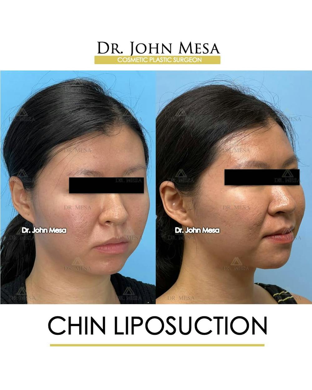 Chin Liposuction Before & After Gallery - Patient 157104130 - Image 3