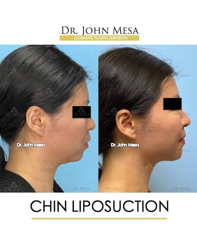 Chin Liposuction Before & After Gallery - Patient 157104130 - Image 1
