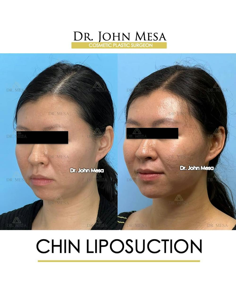 Chin Liposuction Before & After Gallery - Patient 157104130 - Image 4