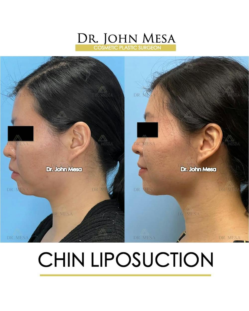 Chin Liposuction Before & After Gallery - Patient 157104130 - Image 5
