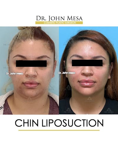 Chin Liposuction Before & After Gallery - Patient 157104131 - Image 2
