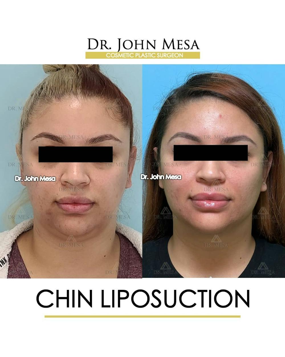 Chin Liposuction Before & After Gallery - Patient 157104131 - Image 1