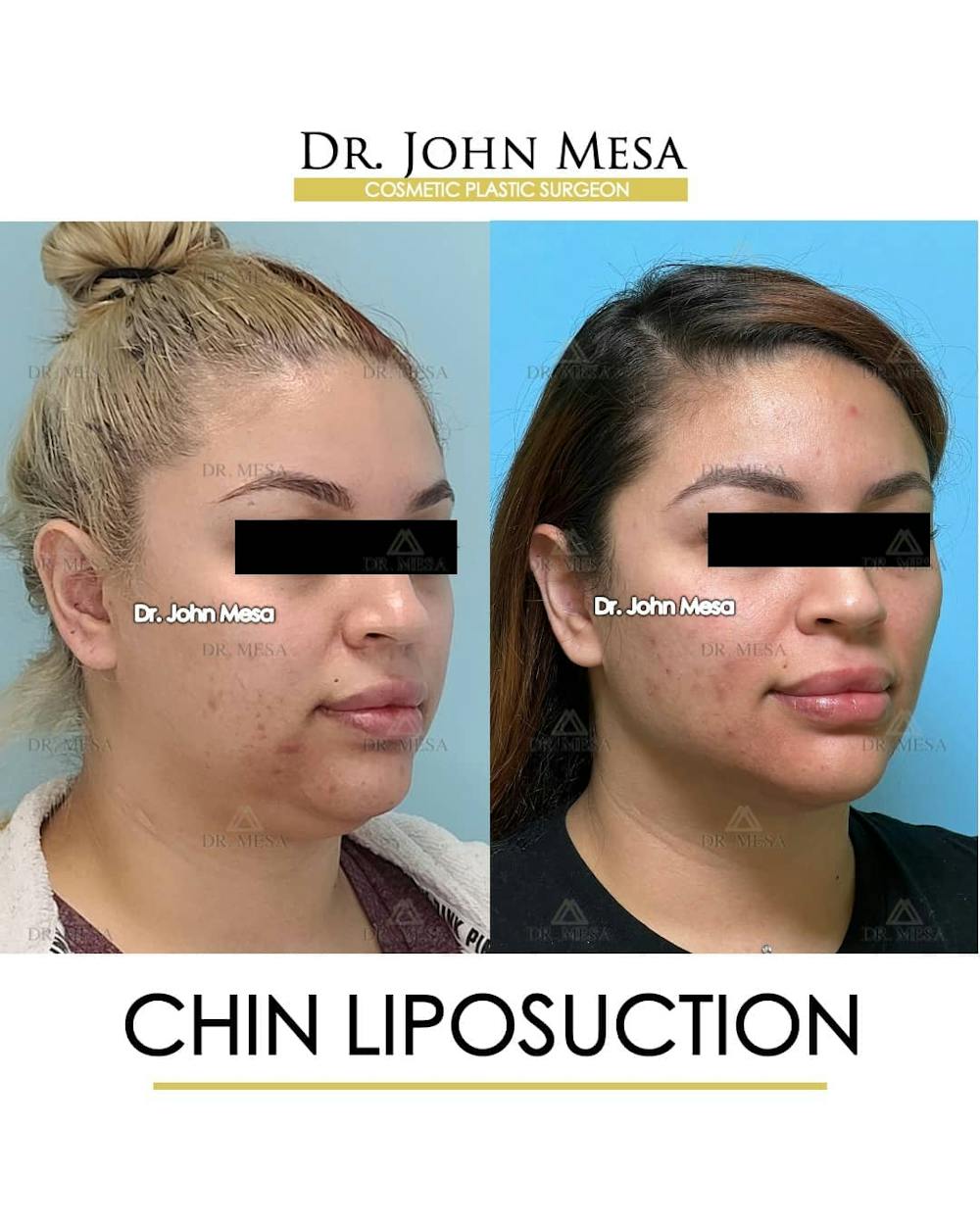 Chin Liposuction Before & After Gallery - Patient 157104131 - Image 3