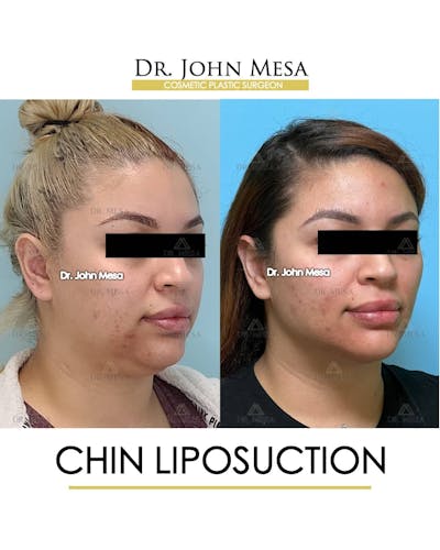 Chin Liposuction Before & After Gallery - Patient 157104131 - Image 2