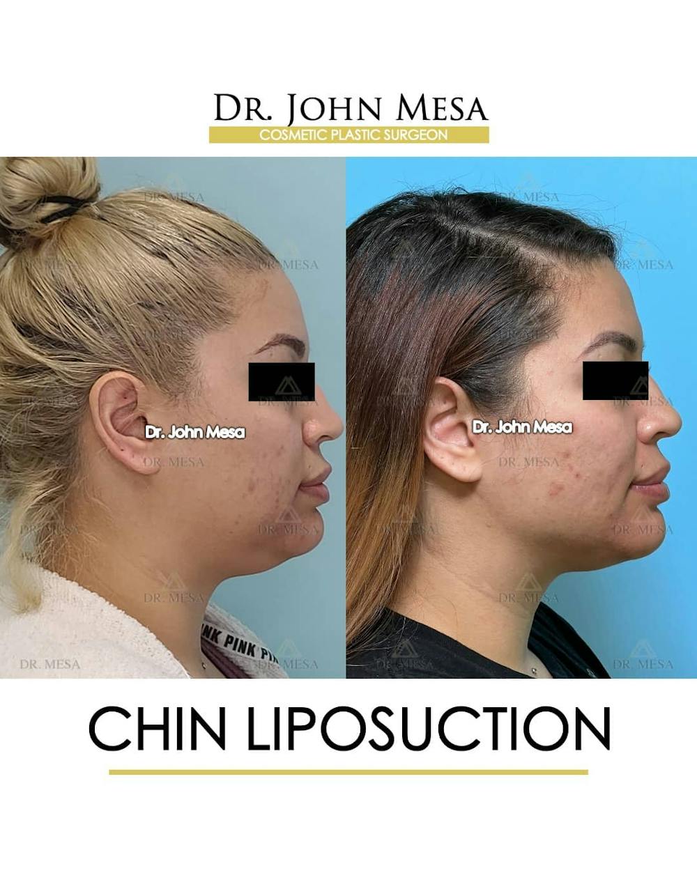 Chin Liposuction Before & After Gallery - Patient 157104131 - Image 3