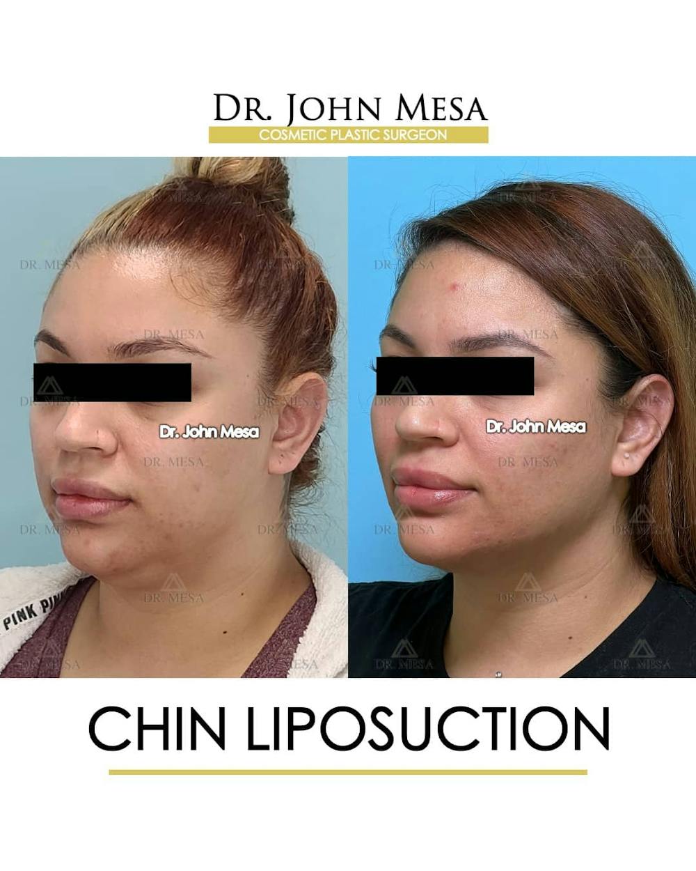 Chin Liposuction Before & After Gallery - Patient 157104131 - Image 4
