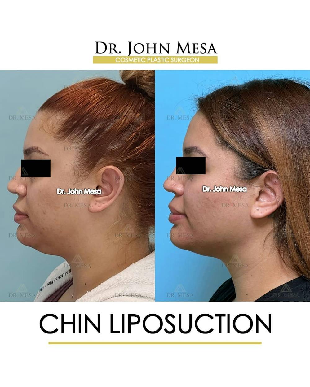Chin Liposuction Before & After Gallery - Patient 157104131 - Image 5