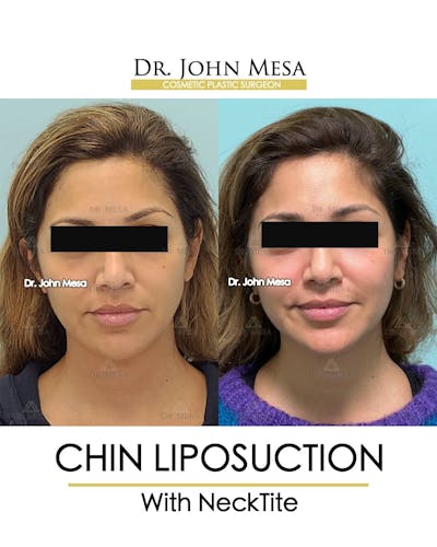 Chin Liposuction Before & After Gallery - Patient 157104126 - Image 2