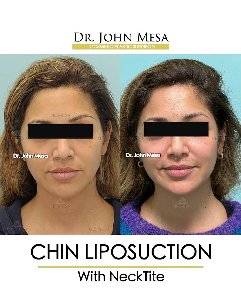 Chin Liposuction Before & After Gallery - Patient 157104126 - Image 1