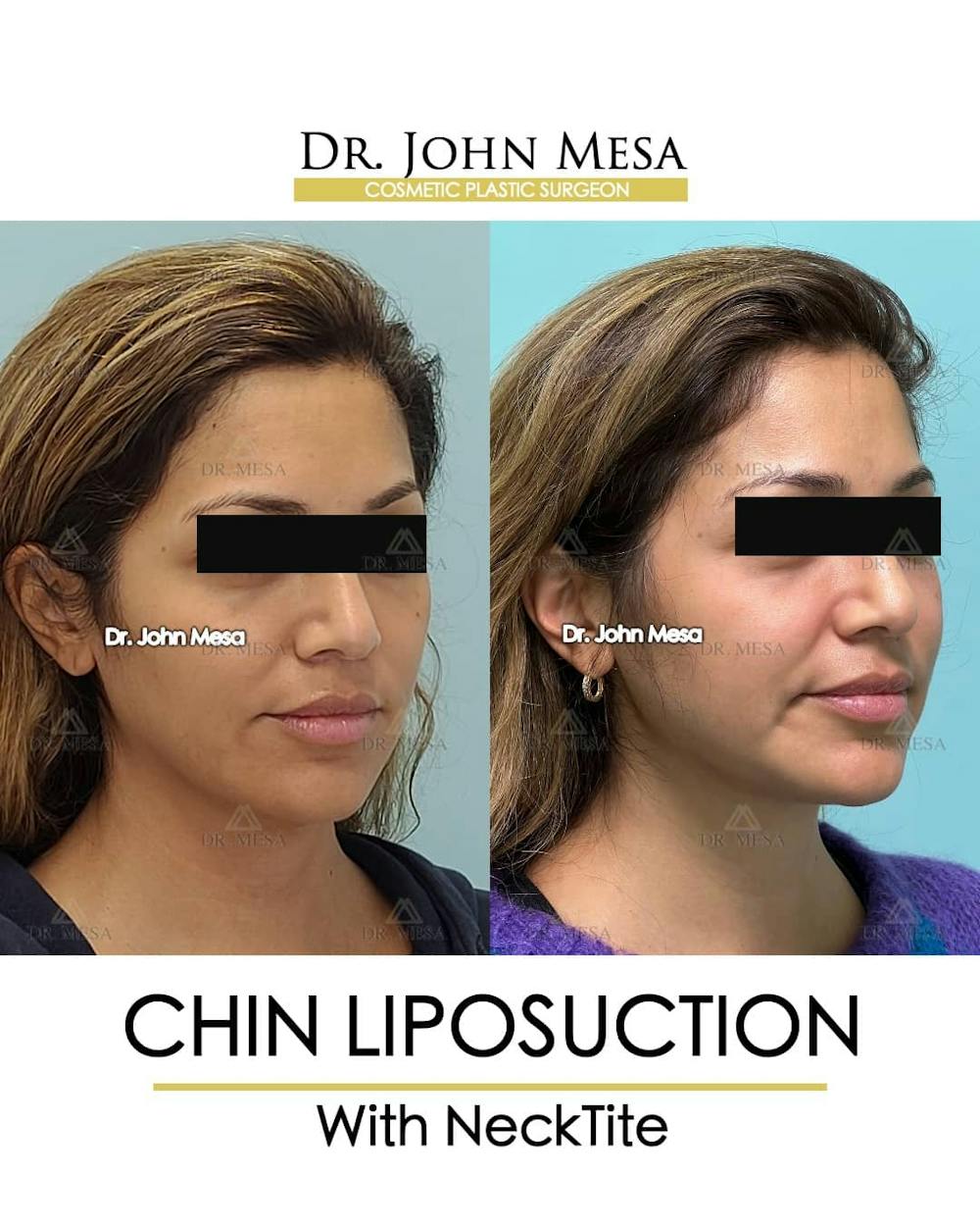 Chin Liposuction Before & After Gallery - Patient 157104126 - Image 3