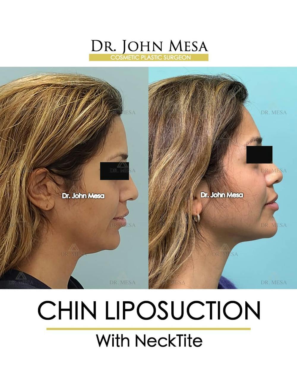 Chin Liposuction Before & After Gallery - Patient 157104126 - Image 1