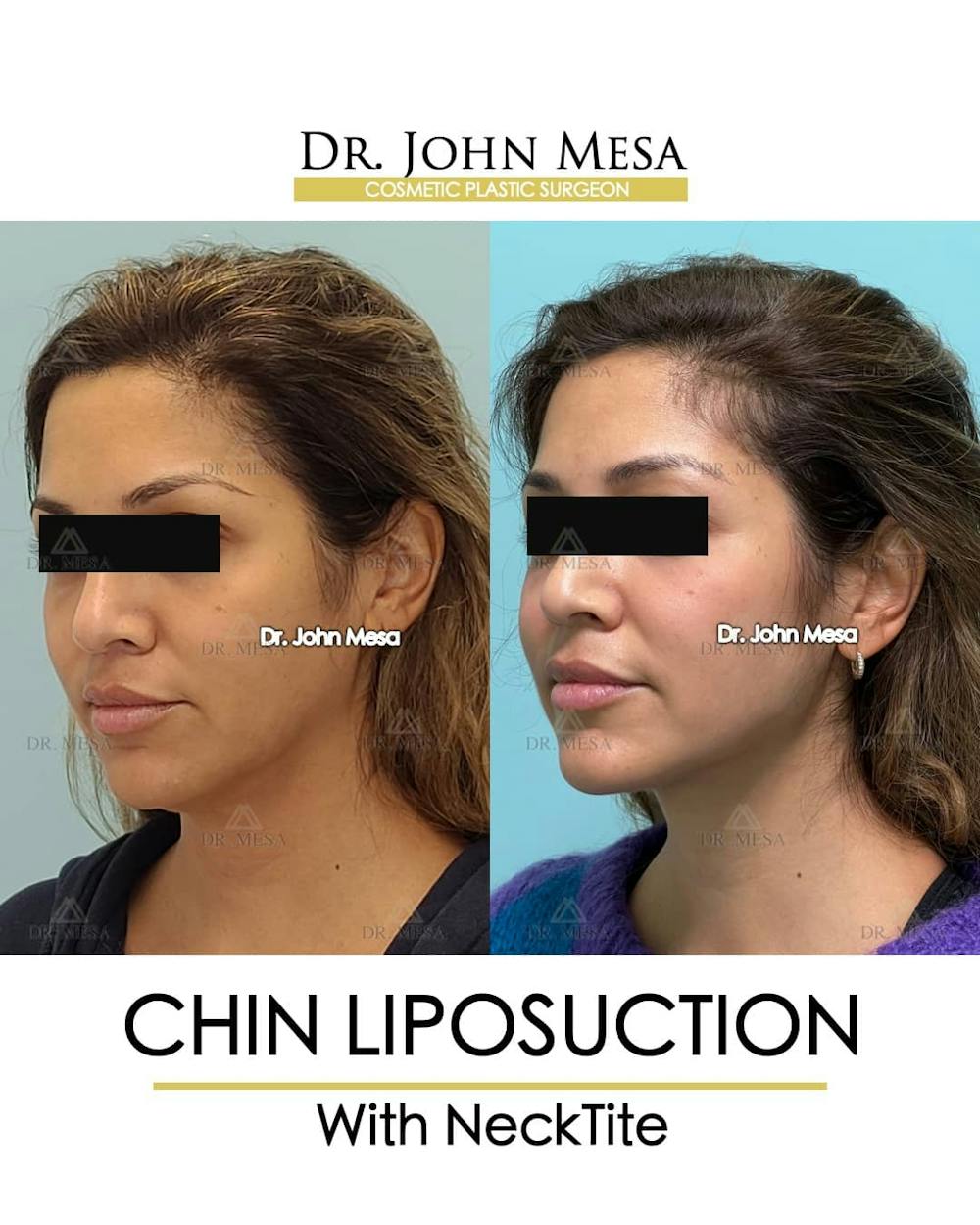 Chin Liposuction Before & After Gallery - Patient 157104126 - Image 4