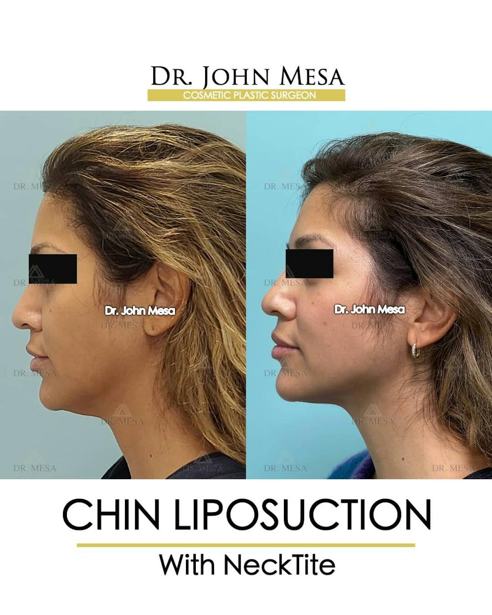 Chin Liposuction Before & After Gallery - Patient 157104126 - Image 5