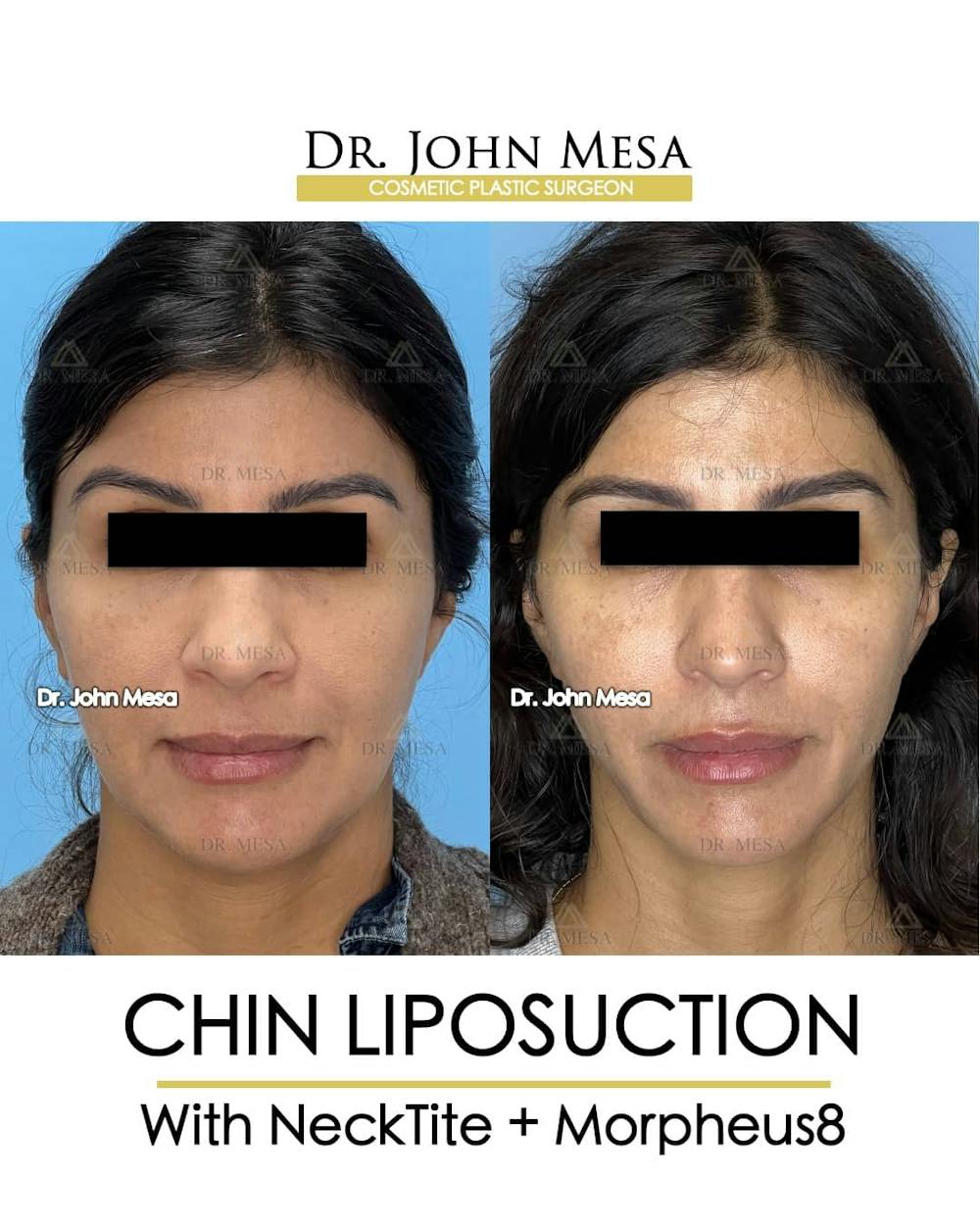 Chin Liposuction Before & After Gallery - Patient 157104124 - Image 2