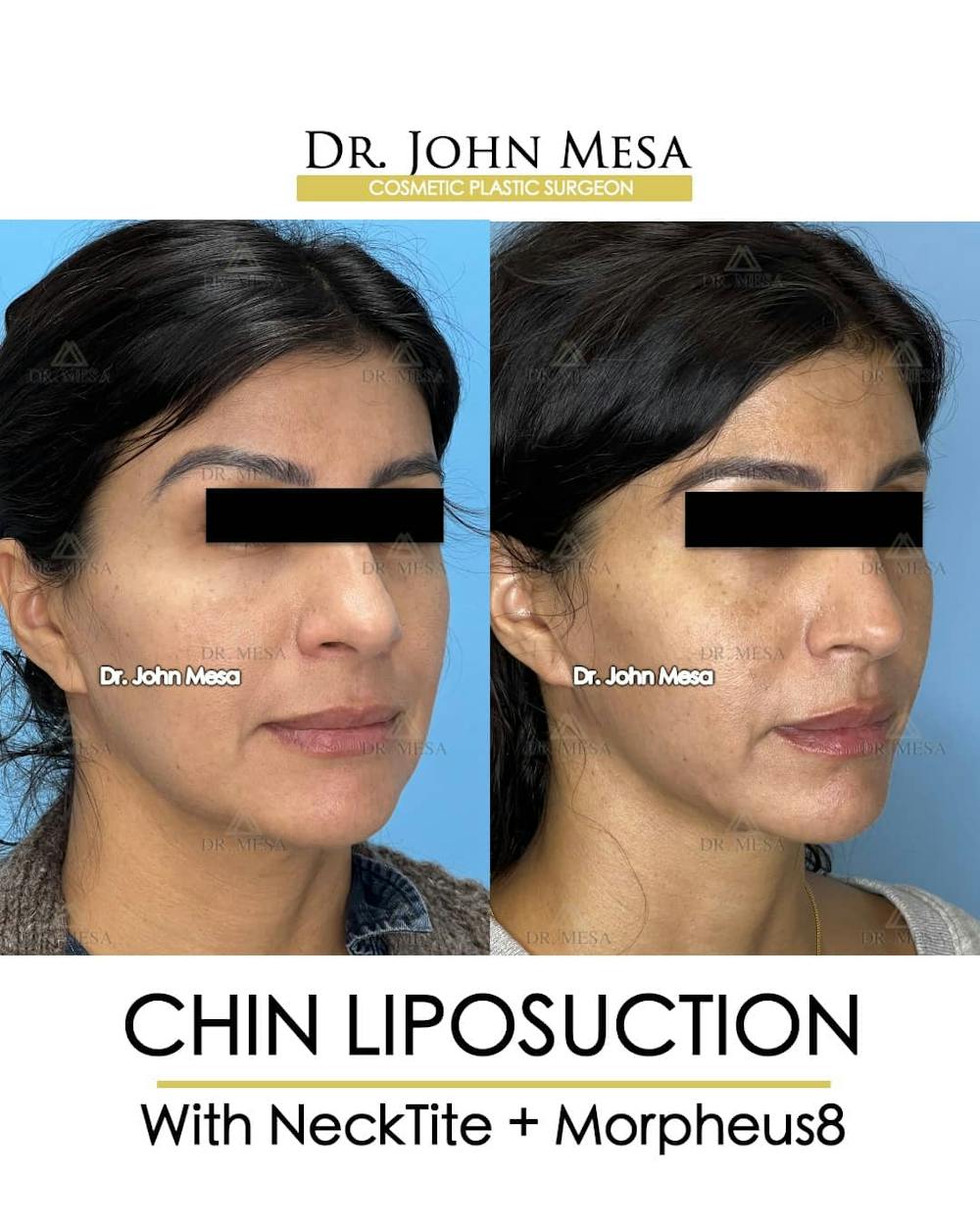 Chin Liposuction Before & After Gallery - Patient 157104124 - Image 3